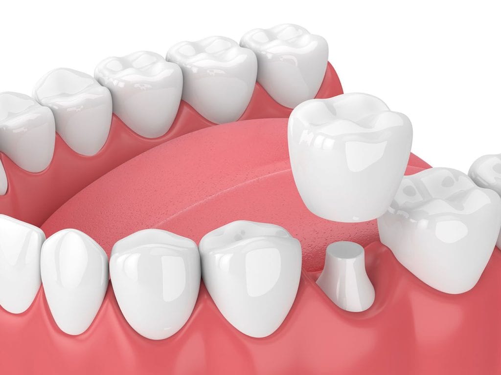 Restorative Dentistry for Broken or Damaged Teeth