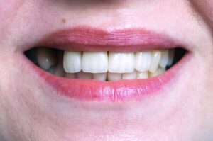 prevent tooth loss in Suffolk Virginia