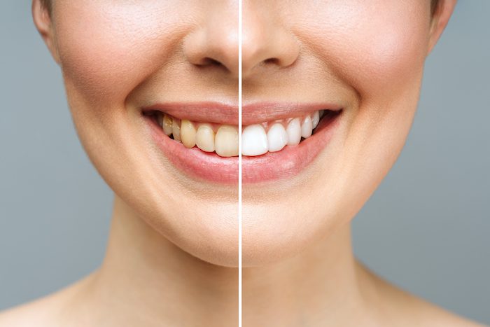 professional teeth whitening in suffolk, virginia