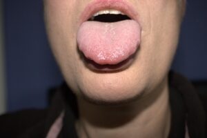 Causes of a Scalloped Tongue