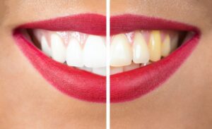 Compare Types of Dental Stains