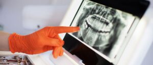 Should I Worry About Non-Vital Tooth Pulp