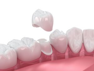 Same-Day Dental Crowns in Suffolk, VA