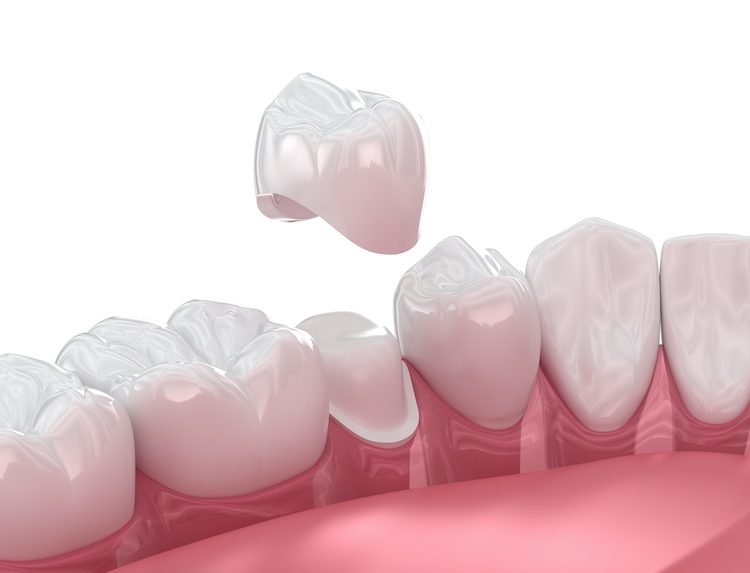Whether you’ve recently undergone a root canal or sustained an injury to your tooth, a dental crown could help restore your smile and bite.