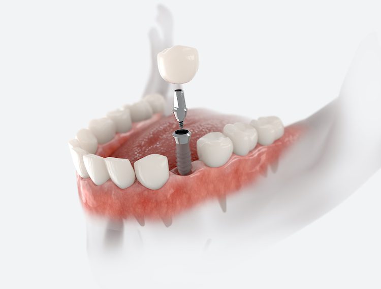 If you’re considering getting a dental implant, understanding what to expect can help ease anxiety and prepare you for the process ahead.
