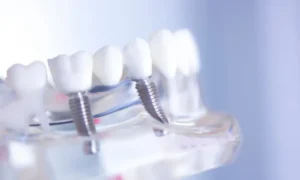 Dental Implants vs. Bridges: Which Is Right for You? in Suffolk, VA